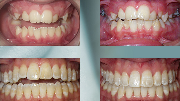 Michael-Riordan-Orthodontics-TAD-intrusion